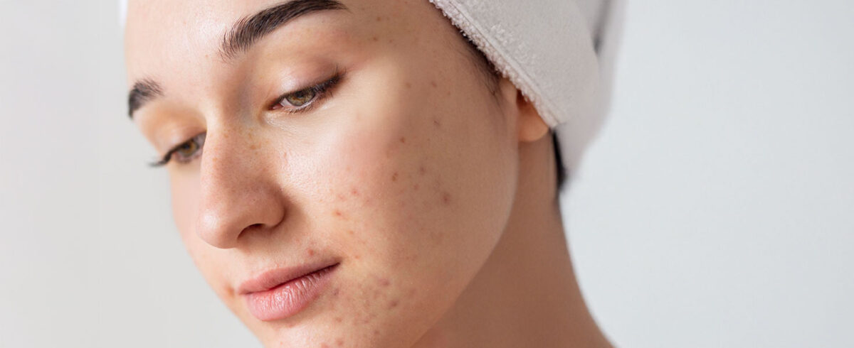 Blog banner Young Skin 1200x490 - Blog -